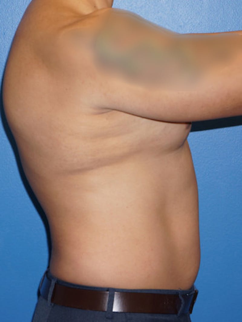 Liposuction Before & After Gallery - Patient 93899479 - Image 3