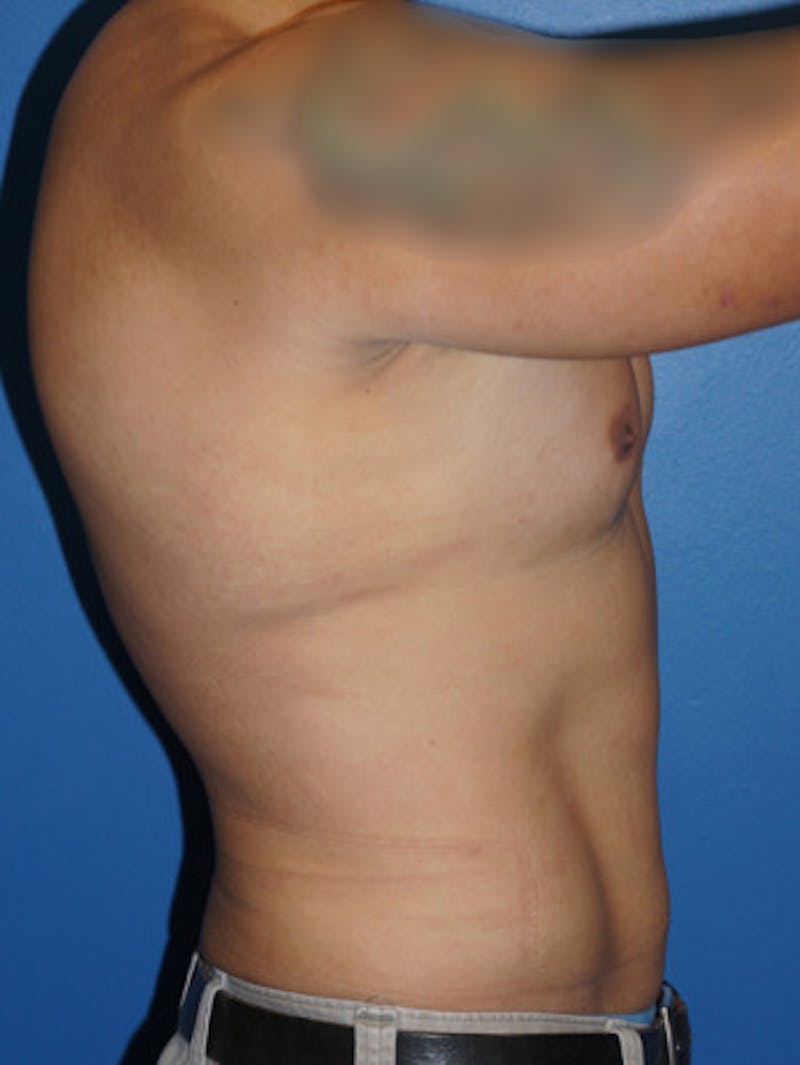 Liposuction Before & After Gallery - Patient 93899479 - Image 4