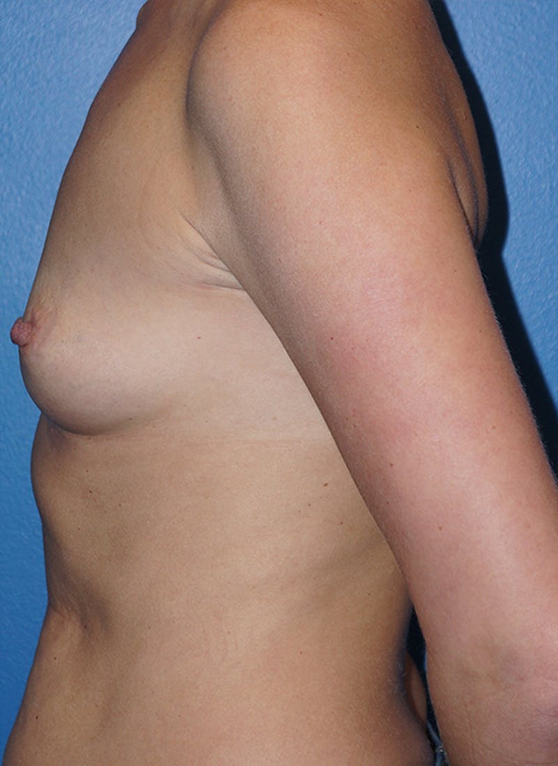 Breast Augmentation Before & After Gallery - Patient 93899516 - Image 5