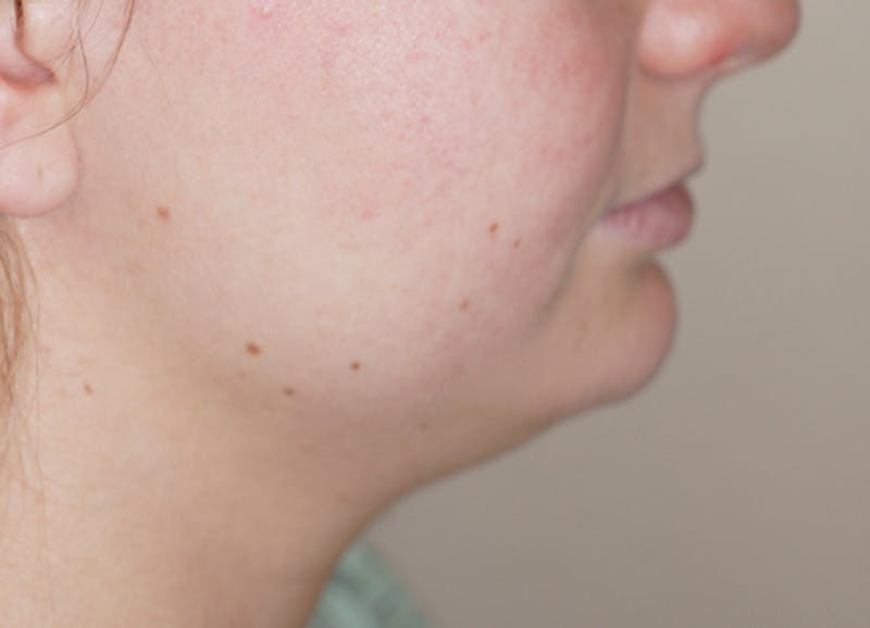 Liposuction Before & After Gallery - Patient 93899493 - Image 1