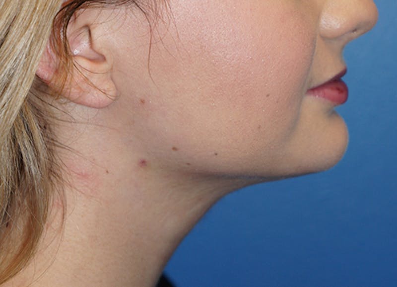 Liposuction Before & After Gallery - Patient 93899493 - Image 2