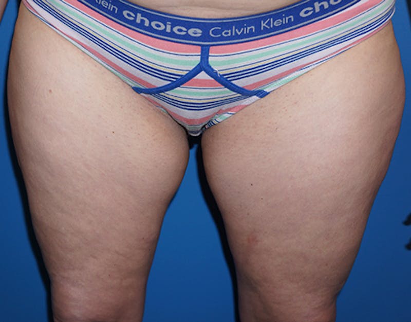 Liposuction Before & After Gallery - Patient 93899513 - Image 1