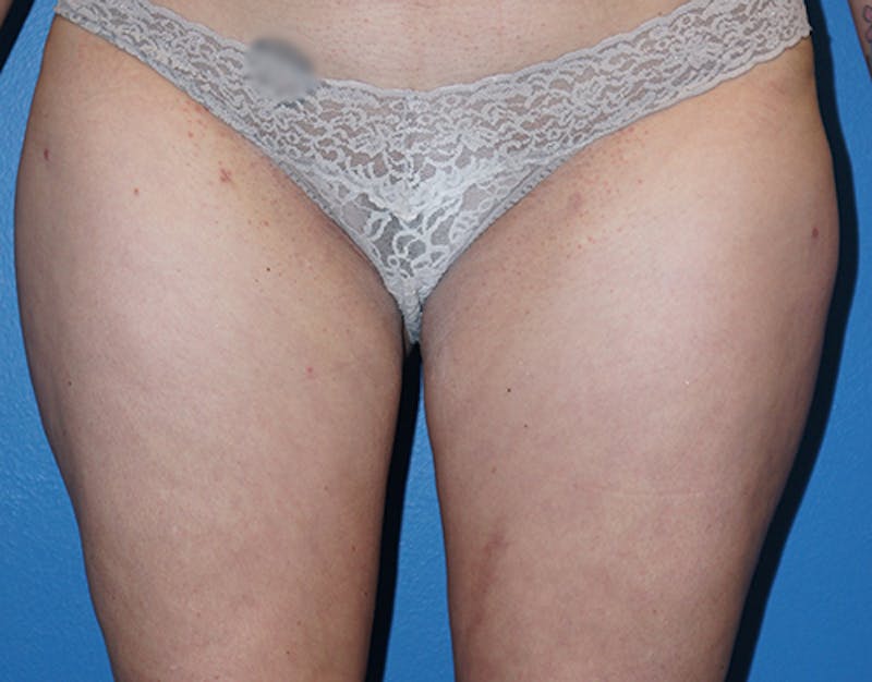 Liposuction Before & After Gallery - Patient 93899513 - Image 2