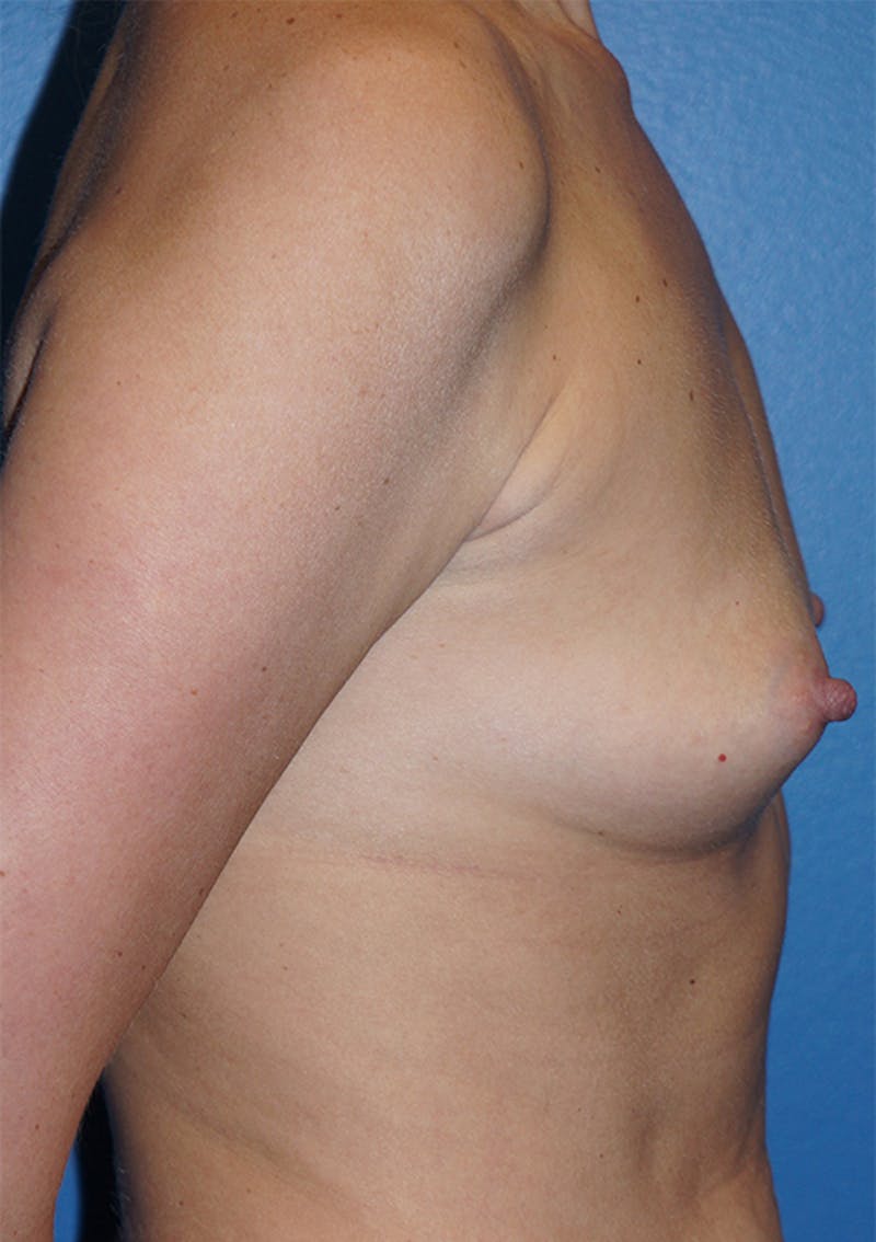 Breast Augmentation Before & After Gallery - Patient 93899516 - Image 9