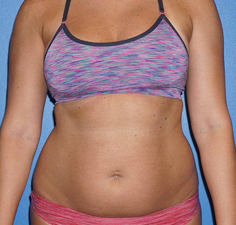 Liposuction Before & After Gallery - Patient 93899541 - Image 1