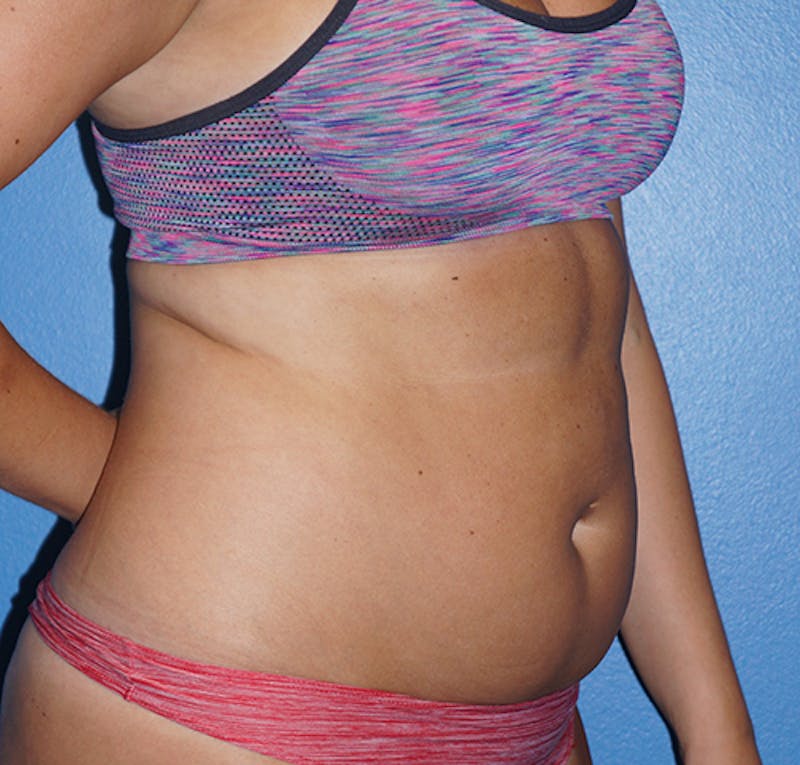 Liposuction Before & After Gallery - Patient 93899541 - Image 3