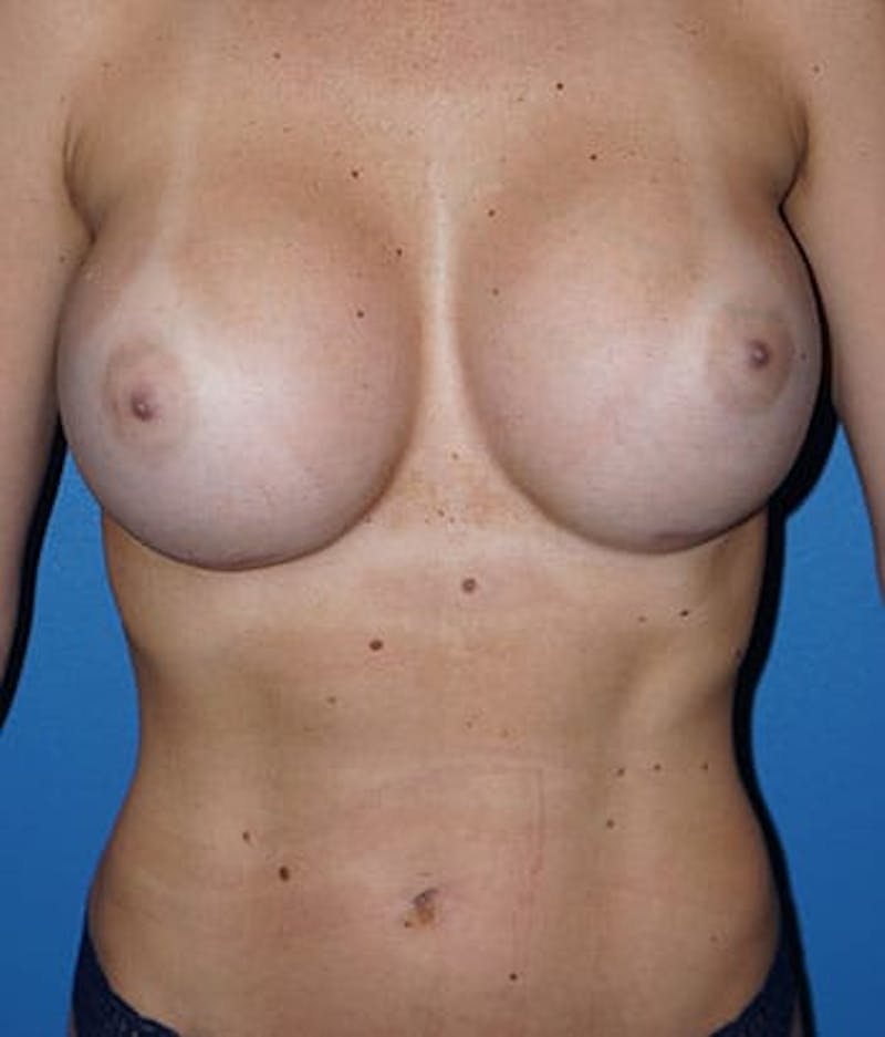 Breast Augmentation Before & After Gallery - Patient 93899540 - Image 2