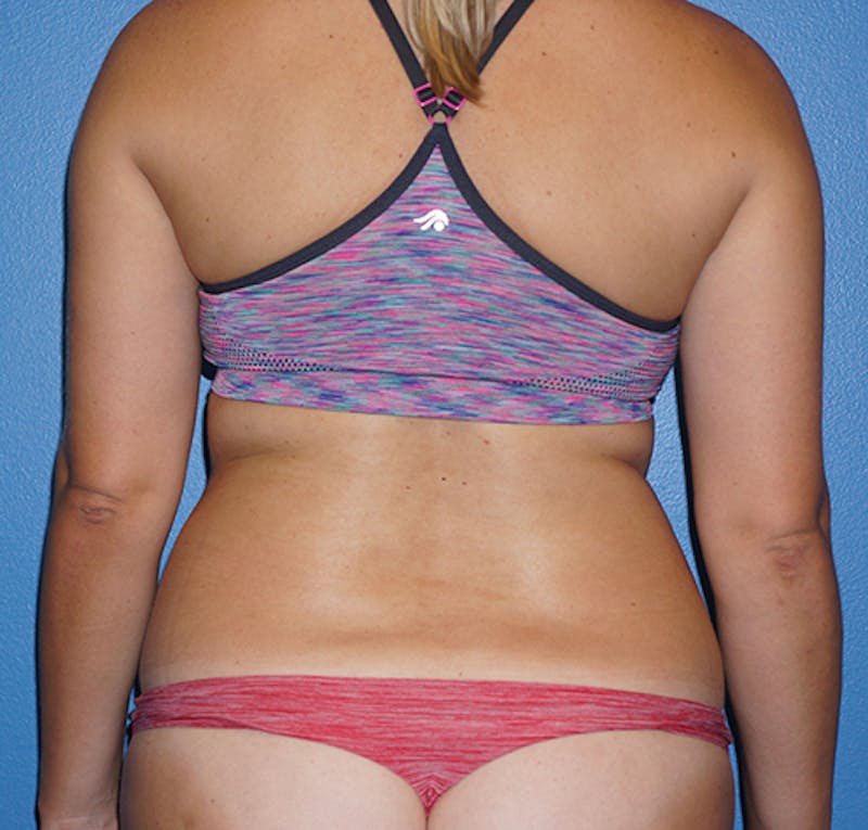 Liposuction Before & After Gallery - Patient 93899541 - Image 5