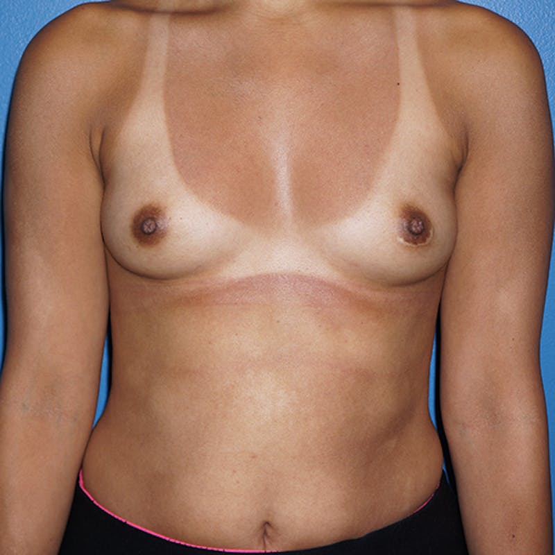 Breast Augmentation Before & After Gallery - Patient 93899609 - Image 1