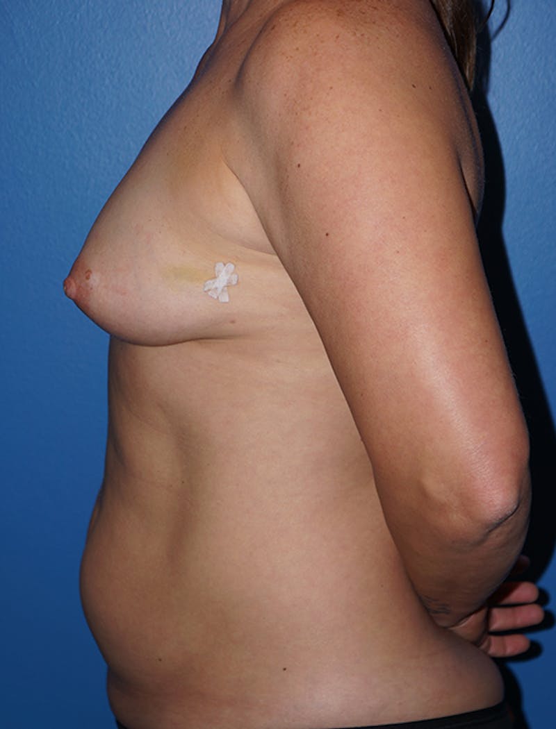 Liposuction Before & After Gallery - Patient 93899556 - Image 1