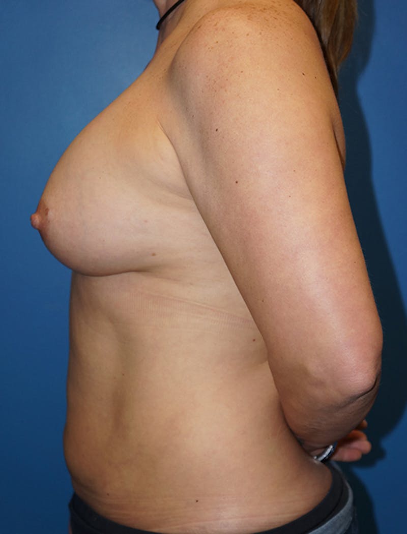 Liposuction Before & After Gallery - Patient 93899556 - Image 2