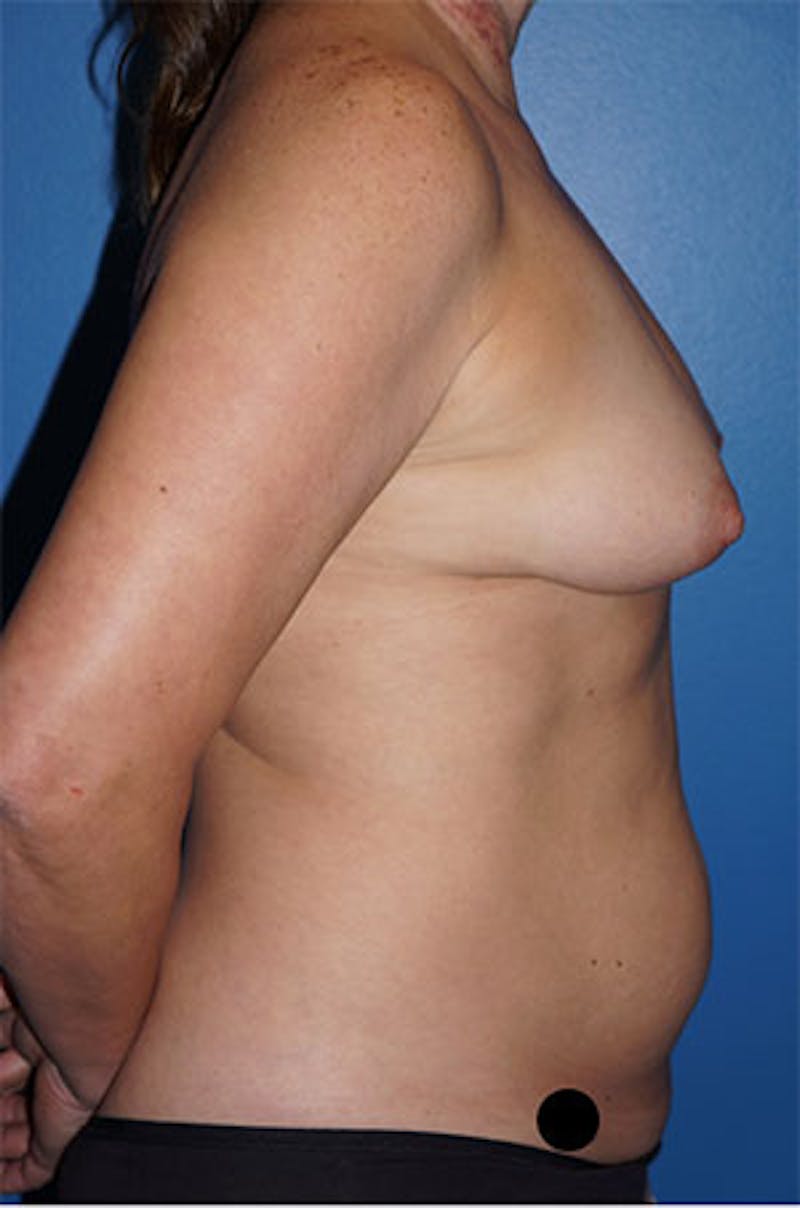 Liposuction Before & After Gallery - Patient 93899571 - Image 1