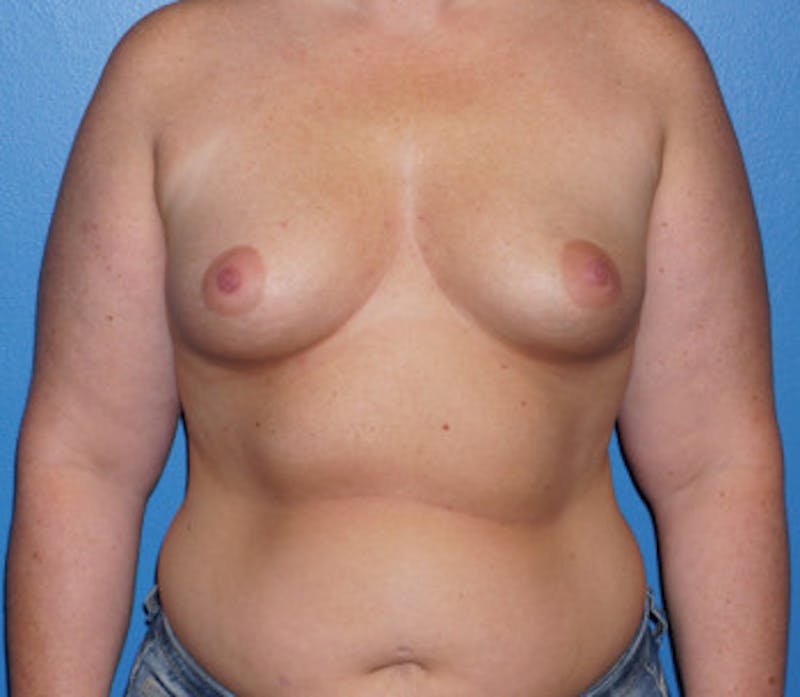 Breast Augmentation Before & After Gallery - Patient 93899660 - Image 1