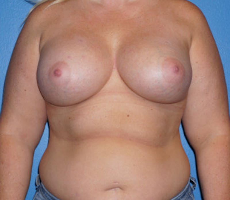 Breast Augmentation Before & After Gallery - Patient 93899660 - Image 2