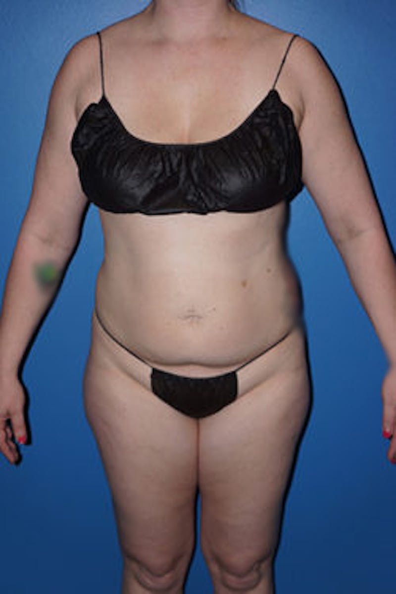 Liposuction Before & After Gallery - Patient 93899659 - Image 1