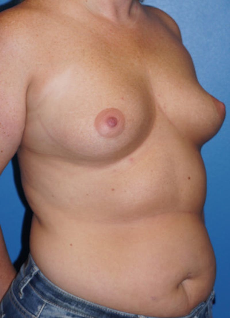 Breast Augmentation Before & After Gallery - Patient 93899660 - Image 3