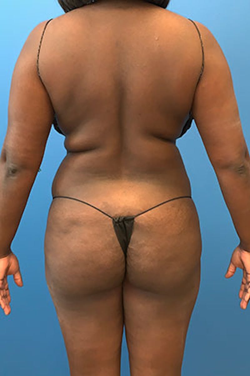 Liposuction Before & After Gallery - Patient 93899676 - Image 1