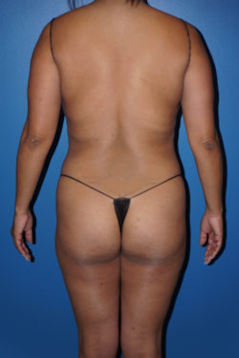 Liposuction Before & After Gallery - Patient 93899696 - Image 1
