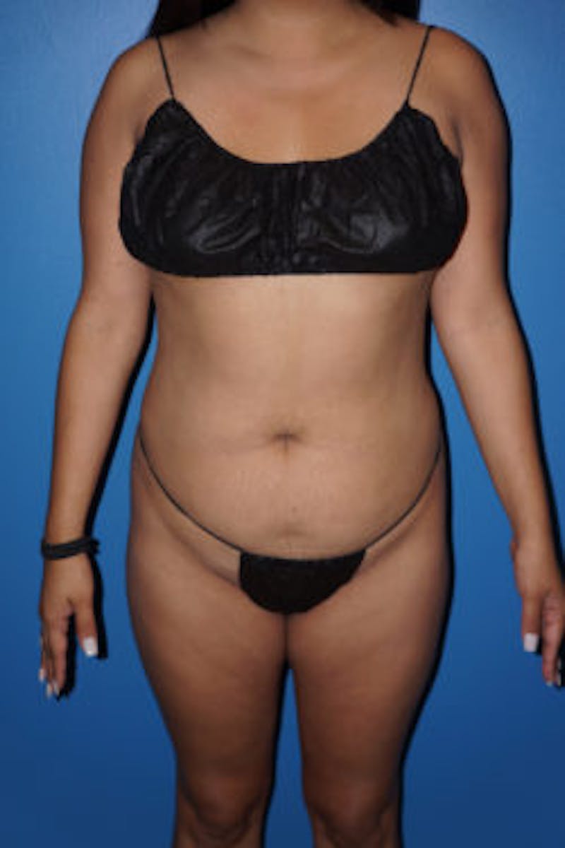 Liposuction Before & After Gallery - Patient 93899696 - Image 3