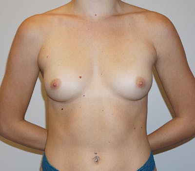 Breast Augmentation Before & After Gallery - Patient 93899722 - Image 1