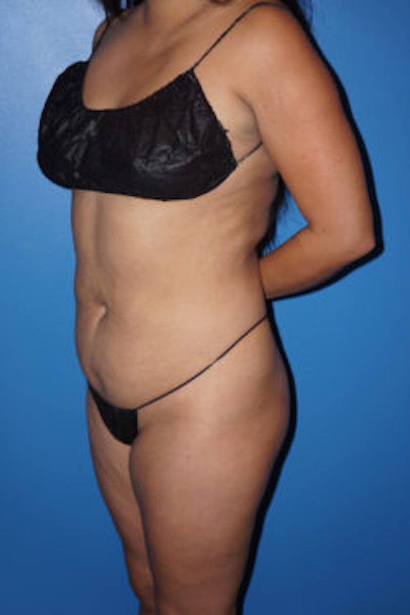 Liposuction Before & After Gallery - Patient 93899696 - Image 5