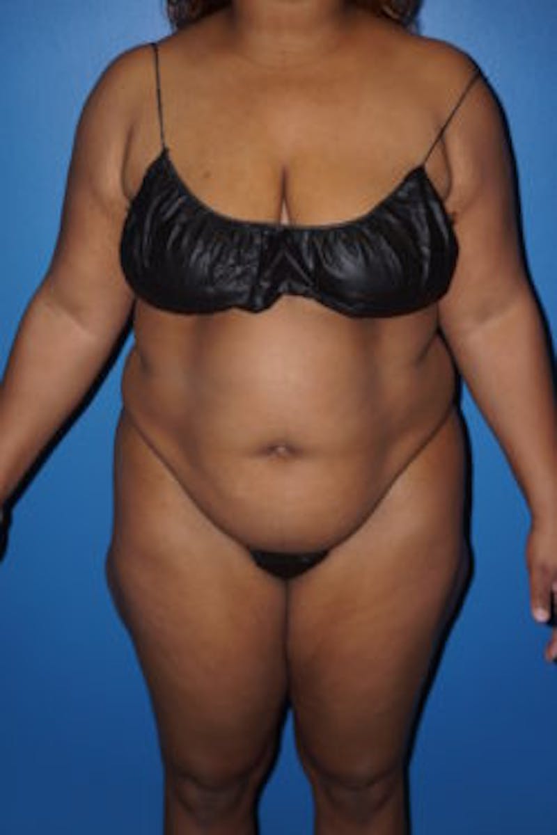 Liposuction Before & After Gallery - Patient 93899725 - Image 1