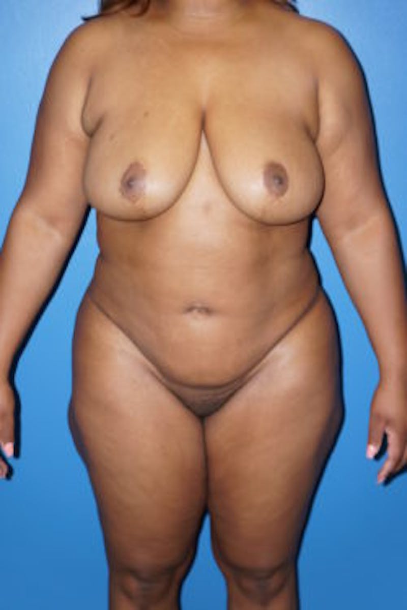 Liposuction Before & After Gallery - Patient 93899725 - Image 2
