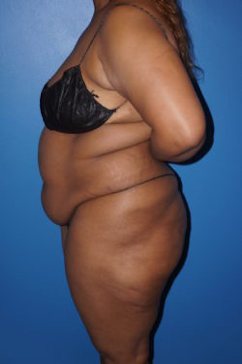 Liposuction Before & After Gallery - Patient 93899725 - Image 3