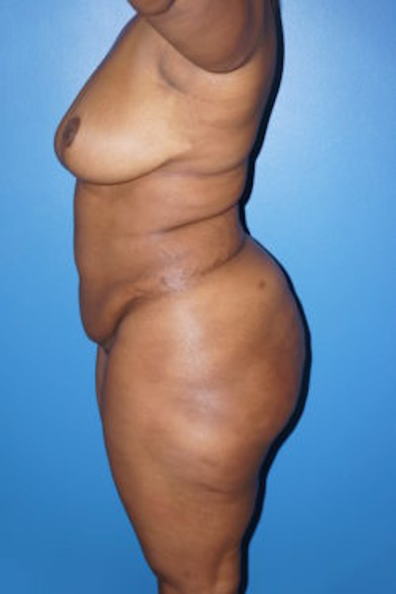 Liposuction Before & After Gallery - Patient 93899725 - Image 4