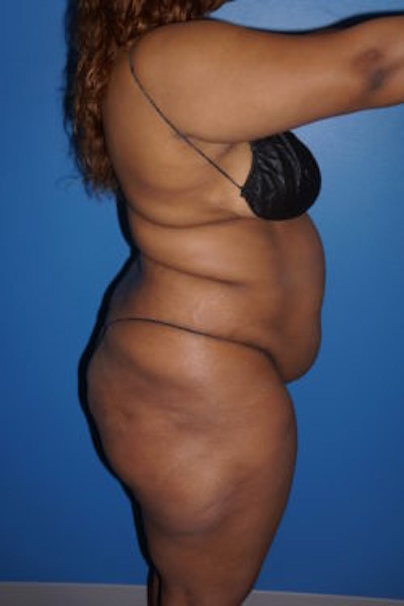 Liposuction Before & After Gallery - Patient 93899725 - Image 5