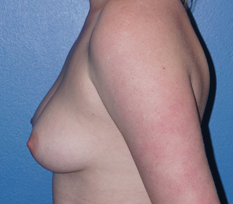 Breast Augmentation Before & After Gallery - Patient 93899726 - Image 3