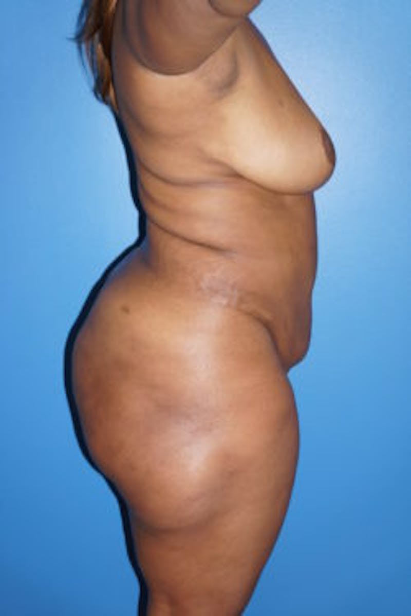 Liposuction Before & After Gallery - Patient 93899725 - Image 6