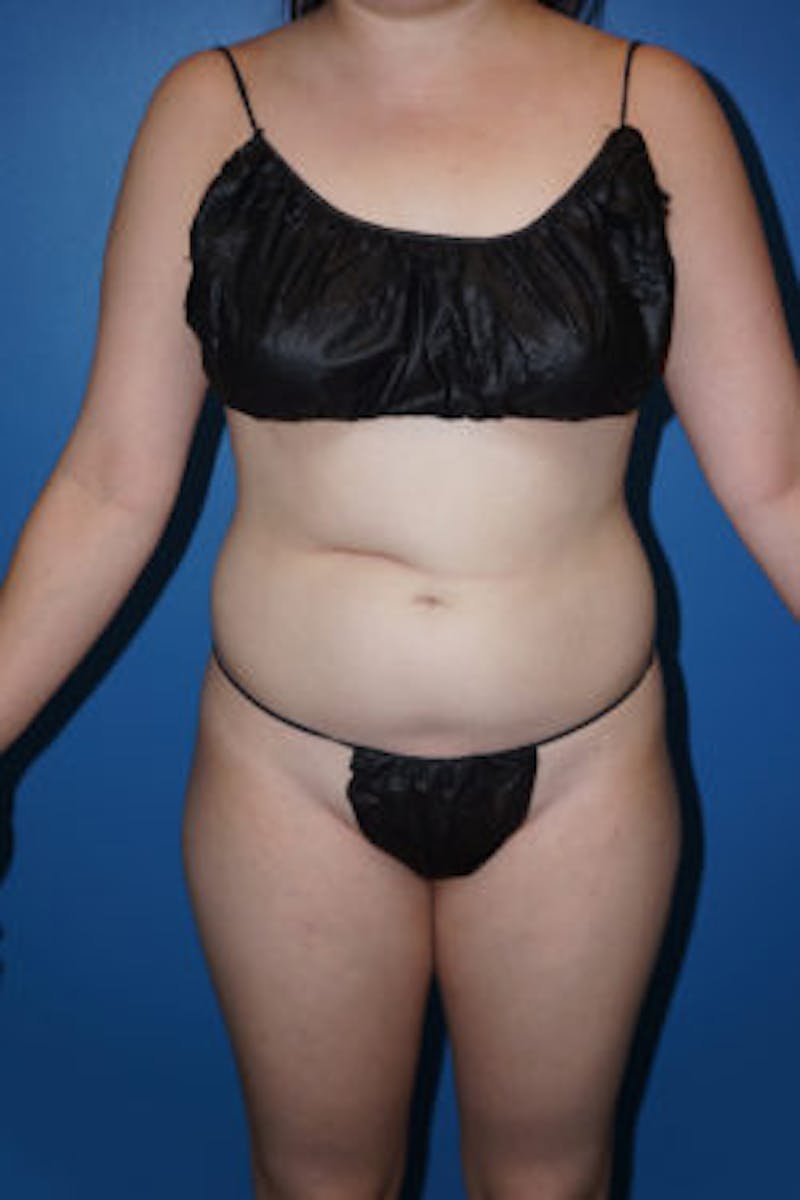 Liposuction Before & After Gallery - Patient 93899730 - Image 1