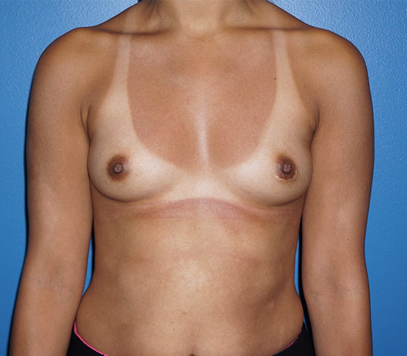Breast Augmentation Before & After Gallery - Patient 93899747 - Image 1