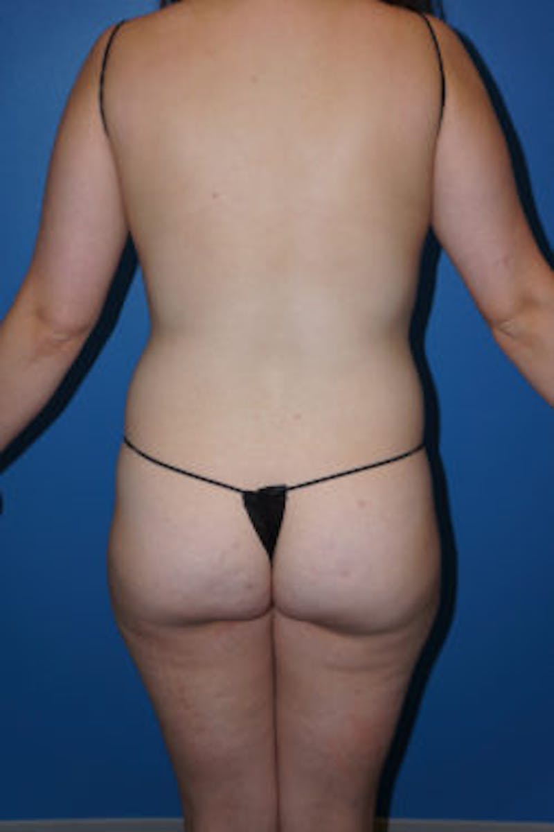 Liposuction Before & After Gallery - Patient 93899730 - Image 3
