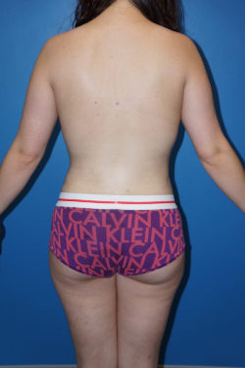 Liposuction Before & After Gallery - Patient 93899730 - Image 4