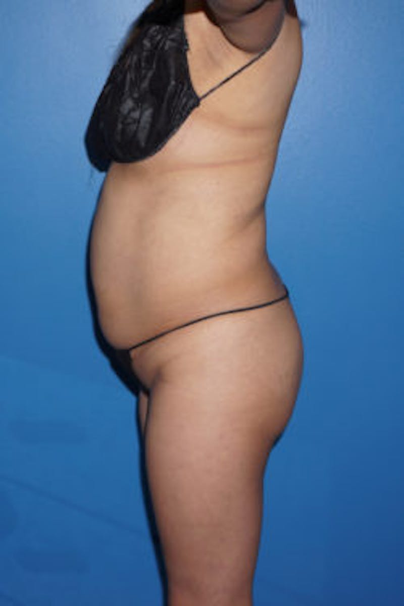 Liposuction Before & After Gallery - Patient 93899766 - Image 3