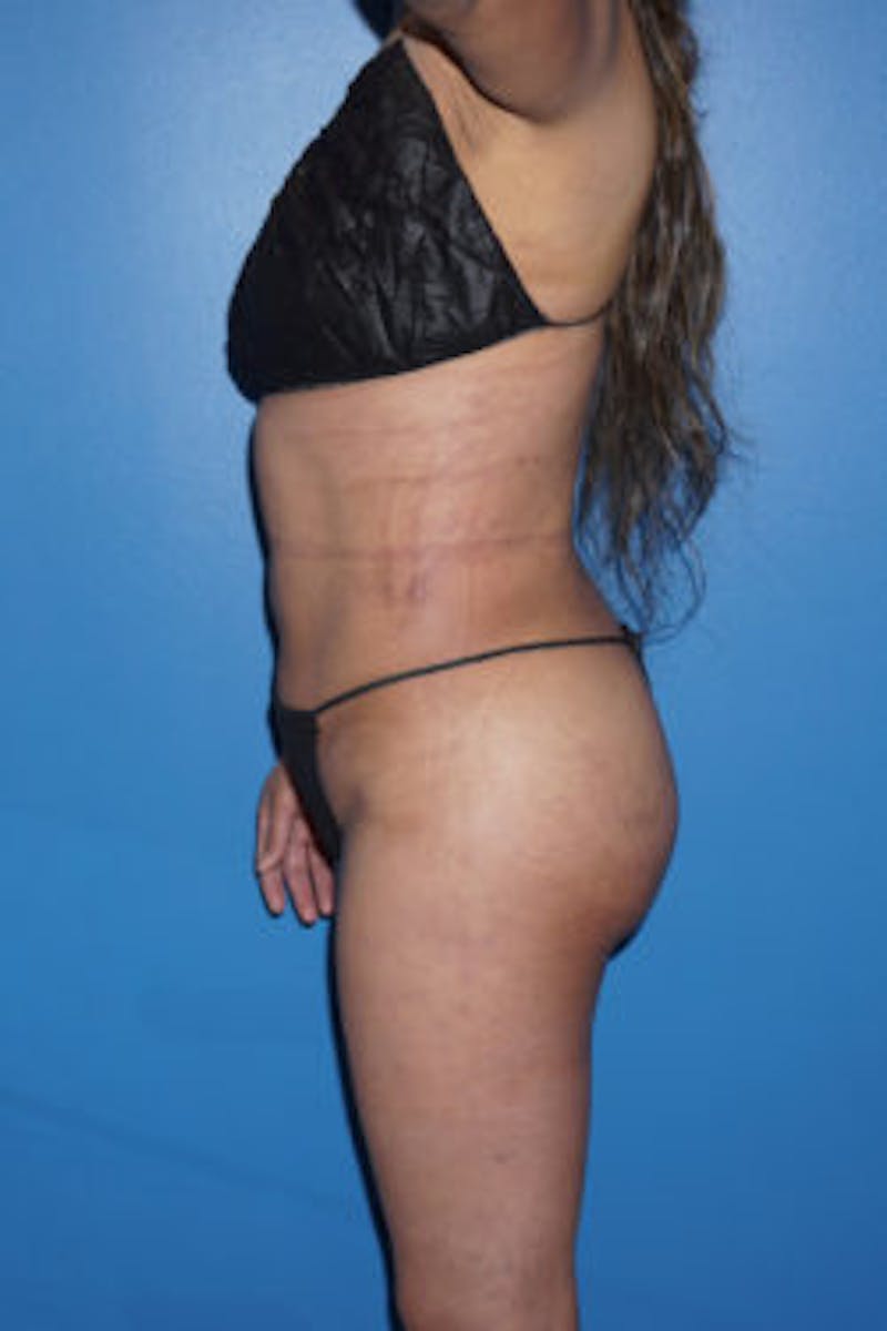 Liposuction Before & After Gallery - Patient 93899766 - Image 4