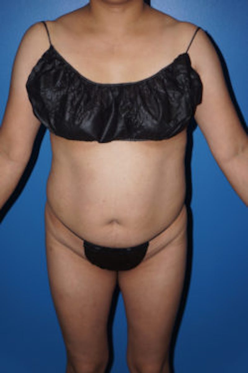 Liposuction Before & After Gallery - Patient 93899766 - Image 5