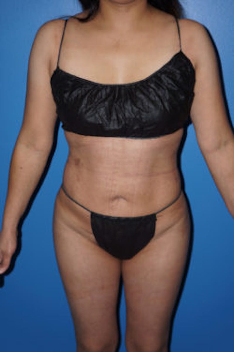 Liposuction Before & After Gallery - Patient 93899766 - Image 6