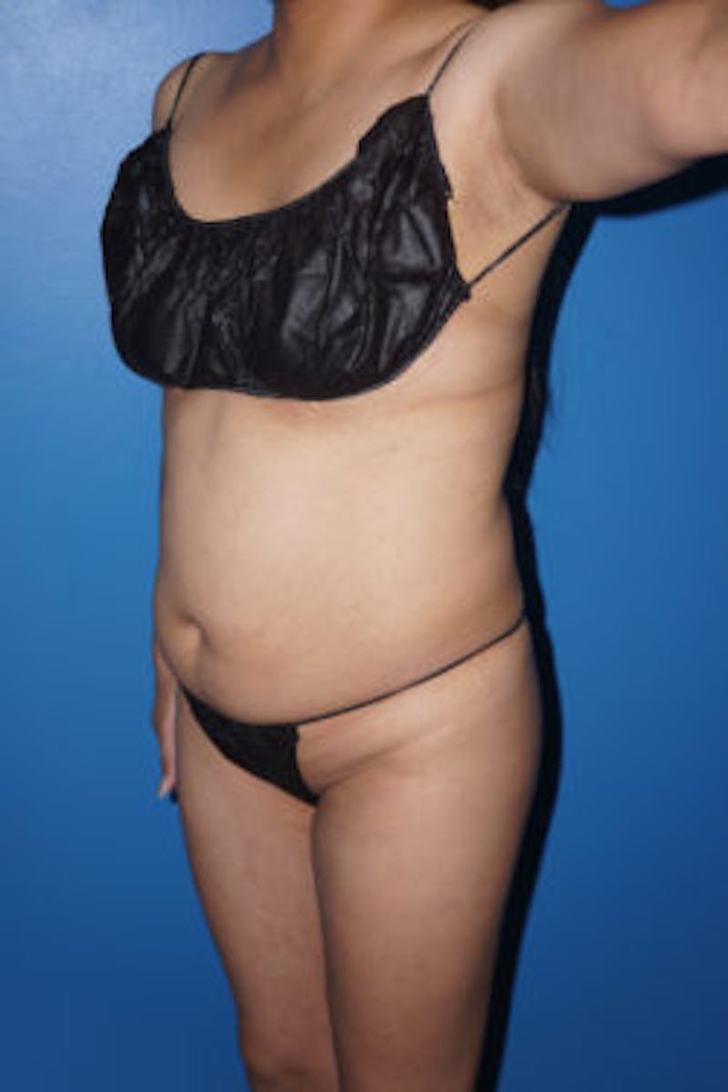 Liposuction Before & After Gallery - Patient 93899766 - Image 7