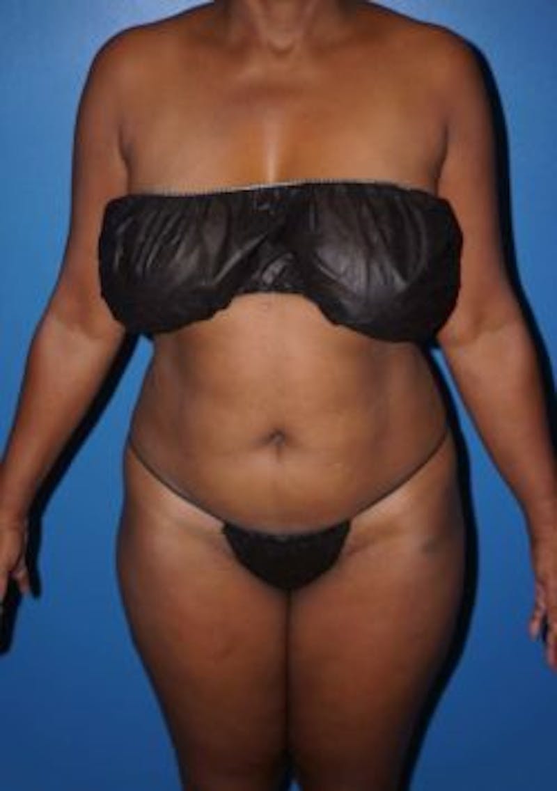 Liposuction Before & After Gallery - Patient 93899773 - Image 1