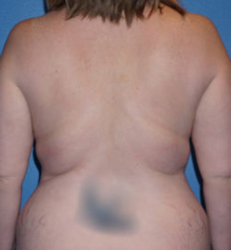 Liposuction Before & After Gallery - Patient 93900113 - Image 1