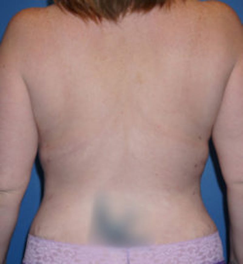 Liposuction Before & After Gallery - Patient 93900113 - Image 2