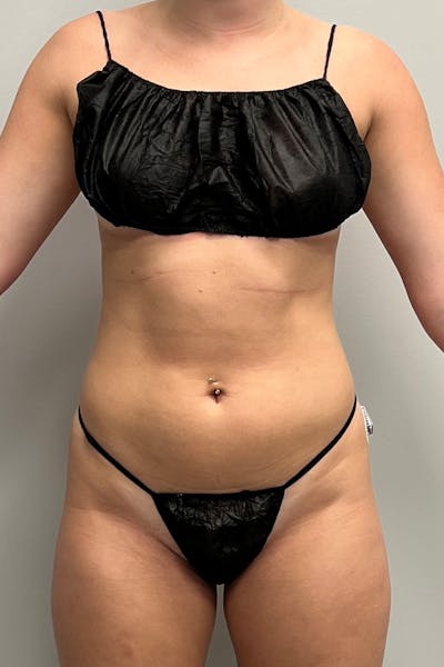 HD Liposuction 360  Before & After Gallery - Patient 417358 - Image 1