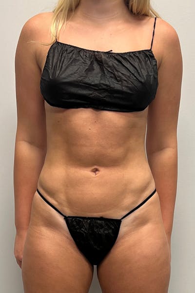 HD Liposuction 360  Before & After Gallery - Patient 417358 - Image 2