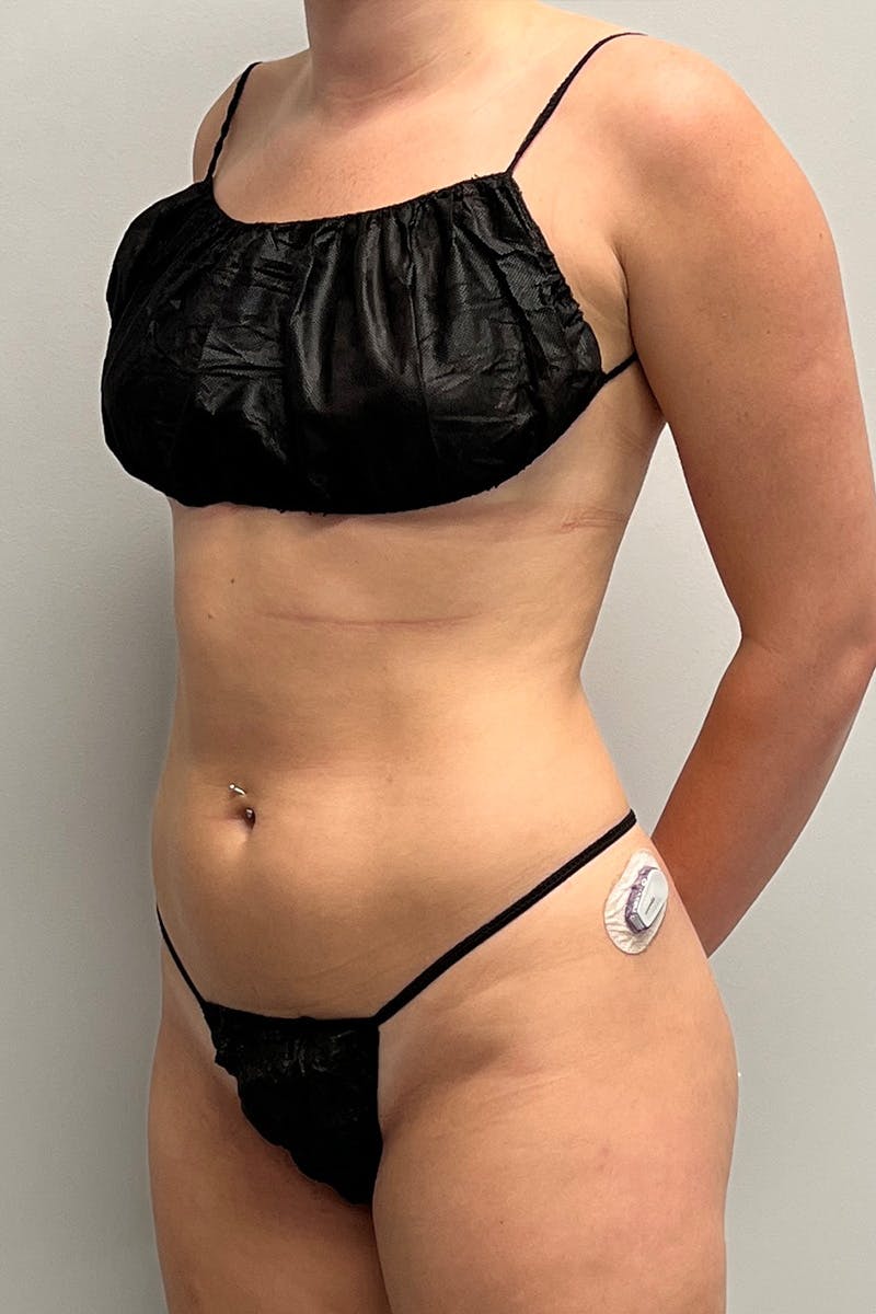 HD Liposuction 360  Before & After Gallery - Patient 417358 - Image 3
