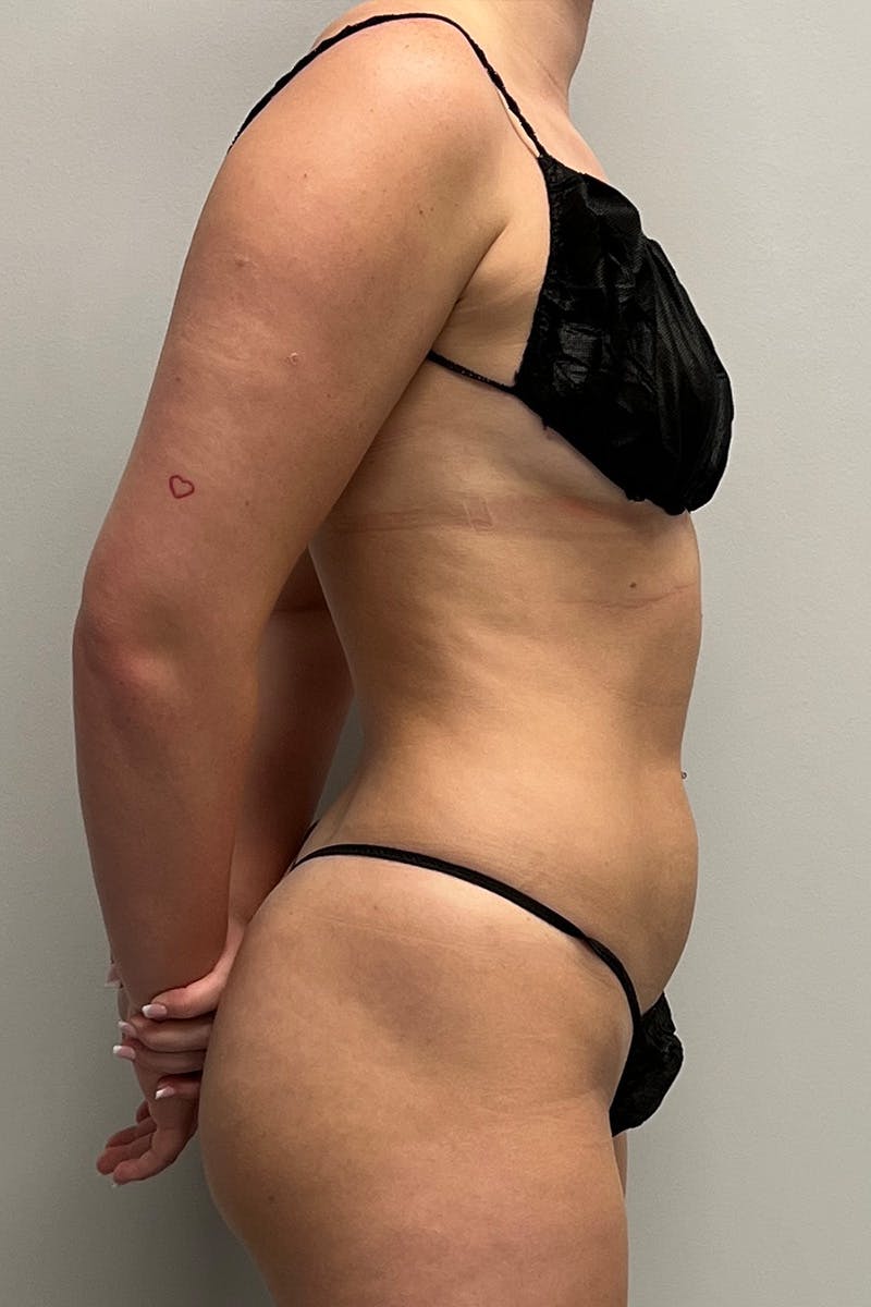 HD Liposuction 360  Before & After Gallery - Patient 417358 - Image 5