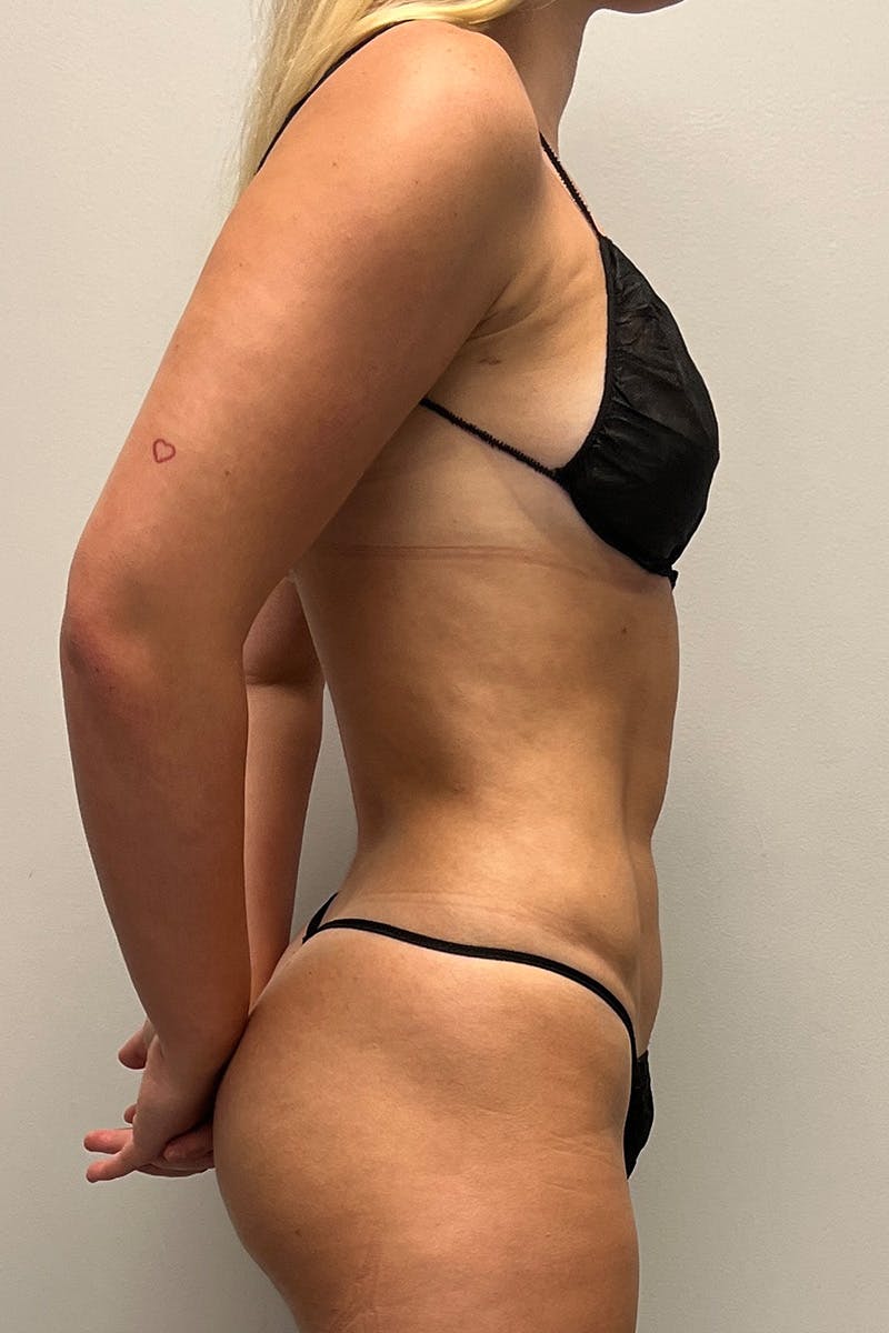 HD Liposuction 360  Before & After Gallery - Patient 417358 - Image 6