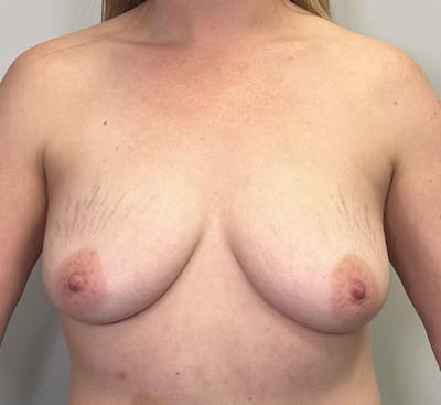 Breast Lift Before & After Gallery - Patient 240189 - Image 1